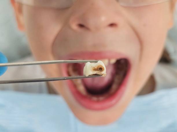 Best Emergency Tooth Extraction in Hillsboro, ND